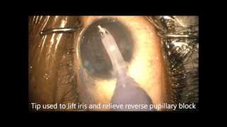 How to Beat Reverse Pupillary Block During Phaco Chris Teng MD [upl. by Edgard]