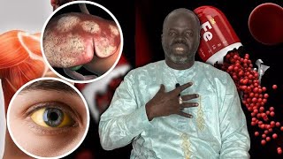 Les CAUSES Hepatomegalie une augmentation du volume du foie Pr Ousmane NDIAYE [upl. by Ennoirb99]