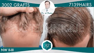 Hair Graft Technique FUE 3002 Grafts 7139 Hairs  Dr de Freitas [upl. by Fidelis]