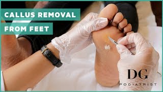 Callus removal from feet balls of feet [upl. by Orapma]