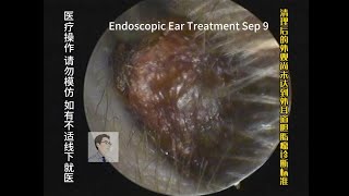 Treatment of cerumen embolization similar to cholesteatoma 20230909 [upl. by Asirrom]