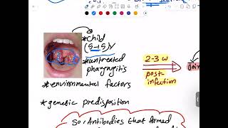 CVS Pathology  Rheumatic Heart Disease  RHD   Mutah [upl. by Mayyahk]