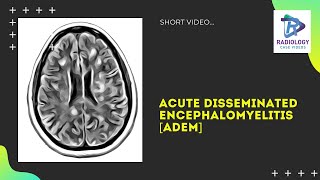 Acute disseminated encephalomyelitis MRI  ADEM Umamaheswara ReddyV [upl. by Antoni]