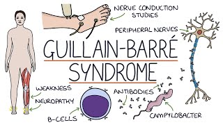 Understanding GuillainBarré Syndrome [upl. by Eatnoled]