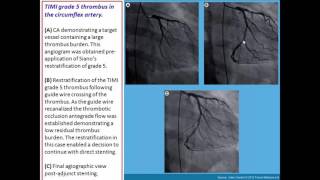 Thrombus containing lesions [upl. by Kcirrez]