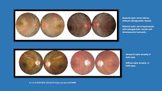 Neurology Quiz 98 Lebers hereditary optic neuropathy LHON [upl. by Keemahs]