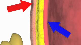 Paracentesis NEJM [upl. by Edaj]