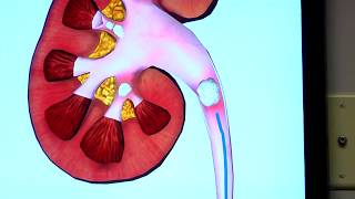 Ureteroscopy Procedure for Kidney Stones [upl. by Anelaf]