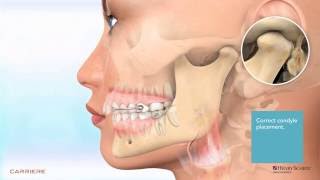 Carriere® Motion™ Appliance for Class II Patient Education Animation 2 [upl. by Eunice264]