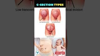 C Section Secrets Revealed ✅ Pregnancy Delivery option  Painless delivery option  Cesarean Section [upl. by Alig]