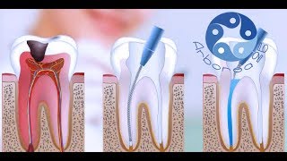 Devitalizzazione Dente con Microscopio e Laser [upl. by Osbourne171]