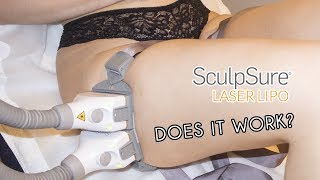 LASER LIPO SculpSure Review [upl. by Nnalyrehs370]