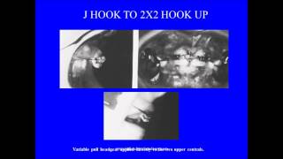 j hook headgear  orthodontic courses by Indian dental academy [upl. by Elesig941]