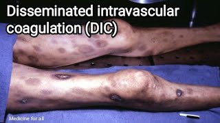 Disseminated intravascular coagulation  DIC  causes symptoms pathologydiagnosis treatment [upl. by Armbruster]