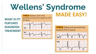 NOTTOMISS condition Wellens syndrome [upl. by Regazzi]