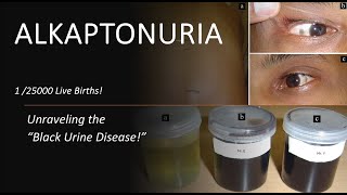 Unraveling ALKAPTONURIA The Mysterious Black Urine Disease [upl. by Akenahs]