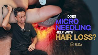 Is Microneedling The Cure For Hair Loss [upl. by Aelak]