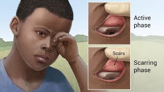 Trachoma  a very common infectious eye disease [upl. by Casteel]