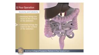 ColostomyIleostomy Your Operation [upl. by Robinett667]