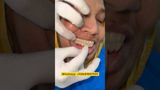 Full Mouth Dental Implant With Fix Teeth ulwe navimumbai mumbaidentalulwe [upl. by Ricki]