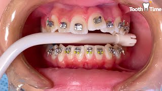 How they put Braces on  13 years old patient  Tooth Time Family Dentistry New Braunfels Texas [upl. by Edelson447]