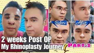 2 Weeks Post OP My Rhinoplasty Journey Part 2 by Doc Ferdinand Lacson Kosmed [upl. by Philippine]