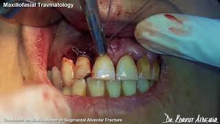 Maxillofacial Travmatology  Treatment On Maxilla Anterior Segmental Aveolar Fracture [upl. by Haile333]