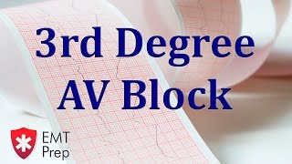 Third Degree Complete Heart Block  EKG ECG Interpretation [upl. by Attikram]