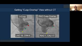 Lecture Cusp Overlap and Commissural Alignment in TAVR [upl. by Eselehs]