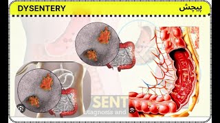 dysentery  pichesh  अतिसार [upl. by Kissie]
