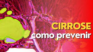 Como prevenir a cirrose hepática  Entenda a prevenção da hepatite  Prof Dr Victor Proença [upl. by Ainigriv]