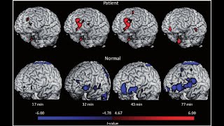 Ambien Zolpidem Tartrate for insomnia and TBI I switched back it continues to work for TBI [upl. by Aeniah]