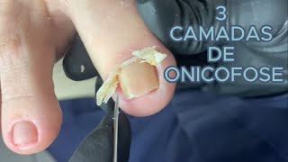 3 CAMADAS DE ONICOFOSE satisfying viral [upl. by Aynwad48]