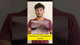 Treatment of Trichomycosis Axillaris dermatology skincaretips shorts skininfection ytshorts [upl. by Ailhad425]