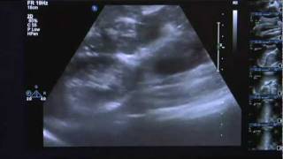 Ultrasound Training Gastrointestinal Tract [upl. by Ycniuq]