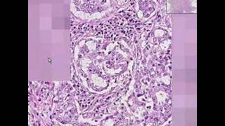 Histopathology LungAdenocarcinoma [upl. by Sheri]