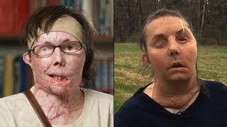 Woman reveals new face months after transplant [upl. by Luane403]