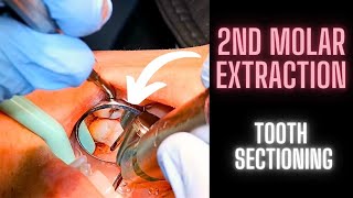 Surgical Extraction of a Maxillary 2nd Molar  Tooth Sectioning  OnlineExodontiacom [upl. by Torhert]