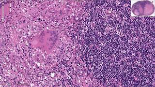 Tuberculosis of the Lymph Node  Histopathology [upl. by Dnalevelc]