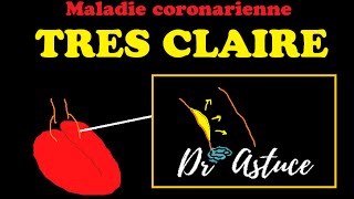 La maladie coronarienne Crise Cardiaque expliquée TRES CLAIREMENT  Dr Astuce [upl. by Ariak]