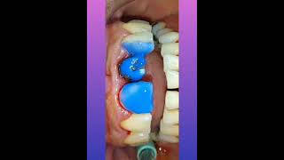 stepsprocedureremoval of old ill fitted crown worn for decades converted to total buildupcosmetic [upl. by Powe]