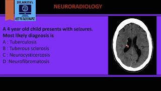 Tuberous sclerosis Neuroradiology [upl. by Nitaf]