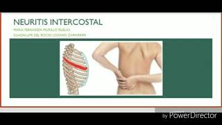 Neuritis intercostal [upl. by Narba]