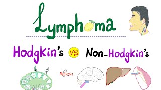 Hodgkin’s Lymphoma vs NonHodgkins Lymphoma  Comparison  Hematology and Oncology [upl. by Ecirp]