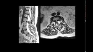 Diastematomielia  Síndrome de regressão caudal tipo 2 [upl. by Massiw]