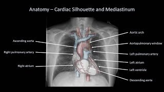 How to Interpret a Chest XRay Lesson 2  A Systematic Method and Anatomy [upl. by Siol]