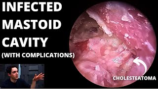 Infected Mastoid Cavity With Cholesteatoma Condylectomy May Be Needed [upl. by Amaerd289]