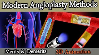 Different Angioplasty Methods Stents Balloon atherectomy Rotablator [upl. by Wiese530]