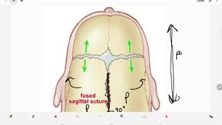 Craniosynostosis [upl. by Aihseken]