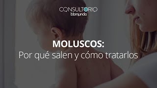 Moluscos qué los ocasiona y cómo tratarlos  Consultorio bbmundo [upl. by Niboc]